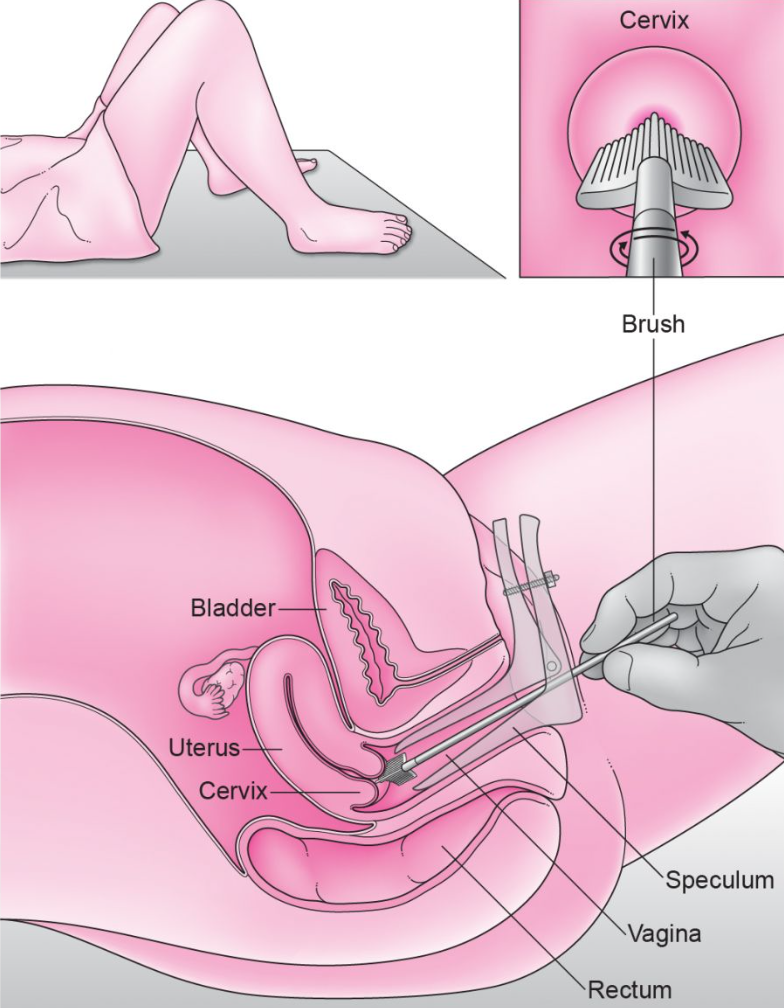 pap-smear