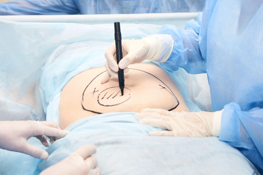 Abdominal_Hysterectomy