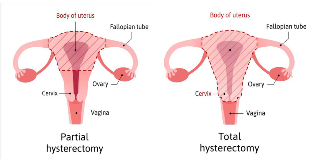 what-to-expect-after-a-hysterectomy-darin-l-weyhrich-m-d-obgyn