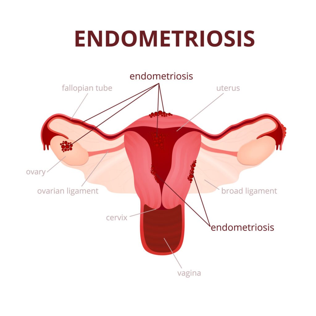 endometriosis