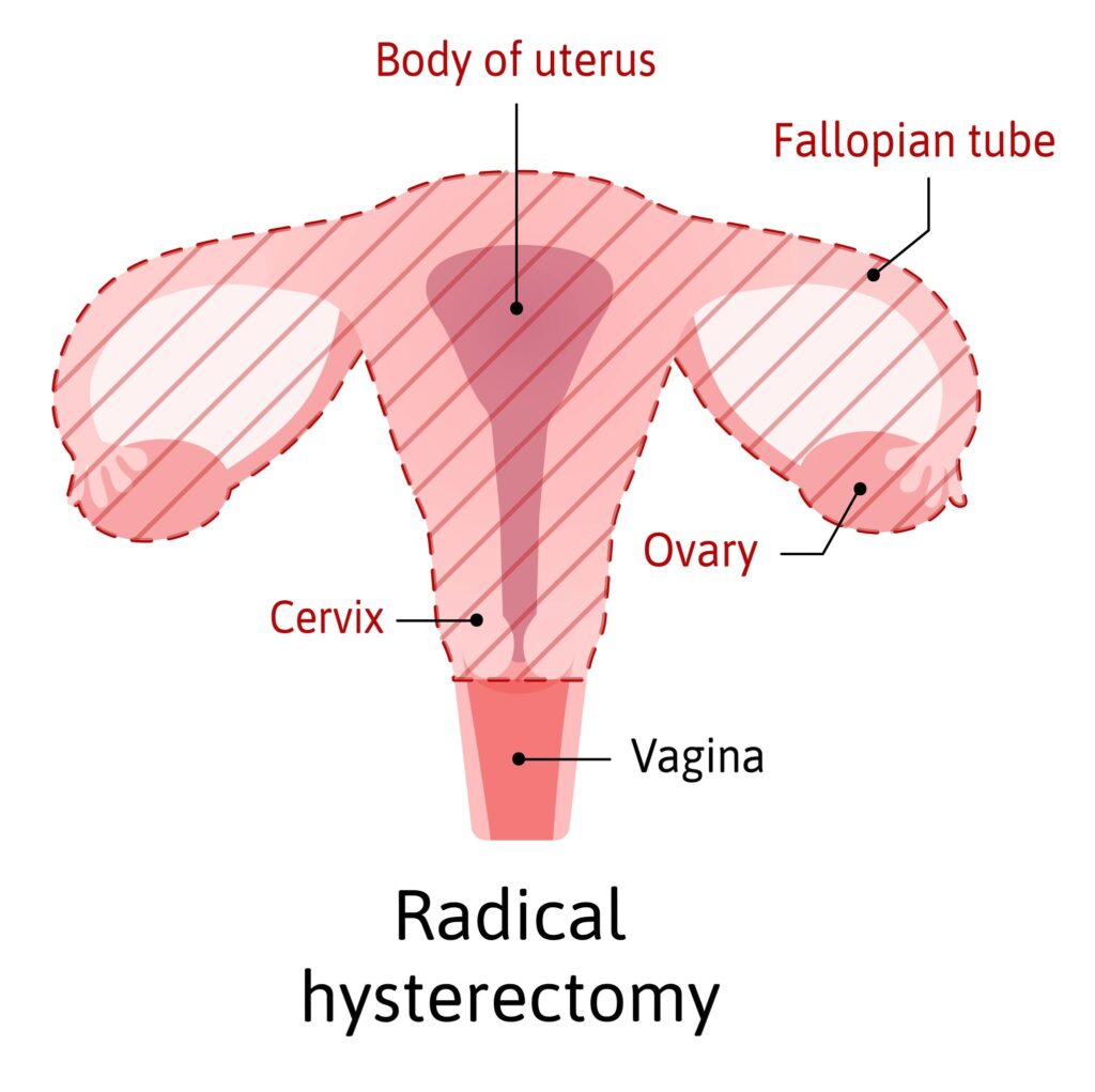 Radical Hysterectomy