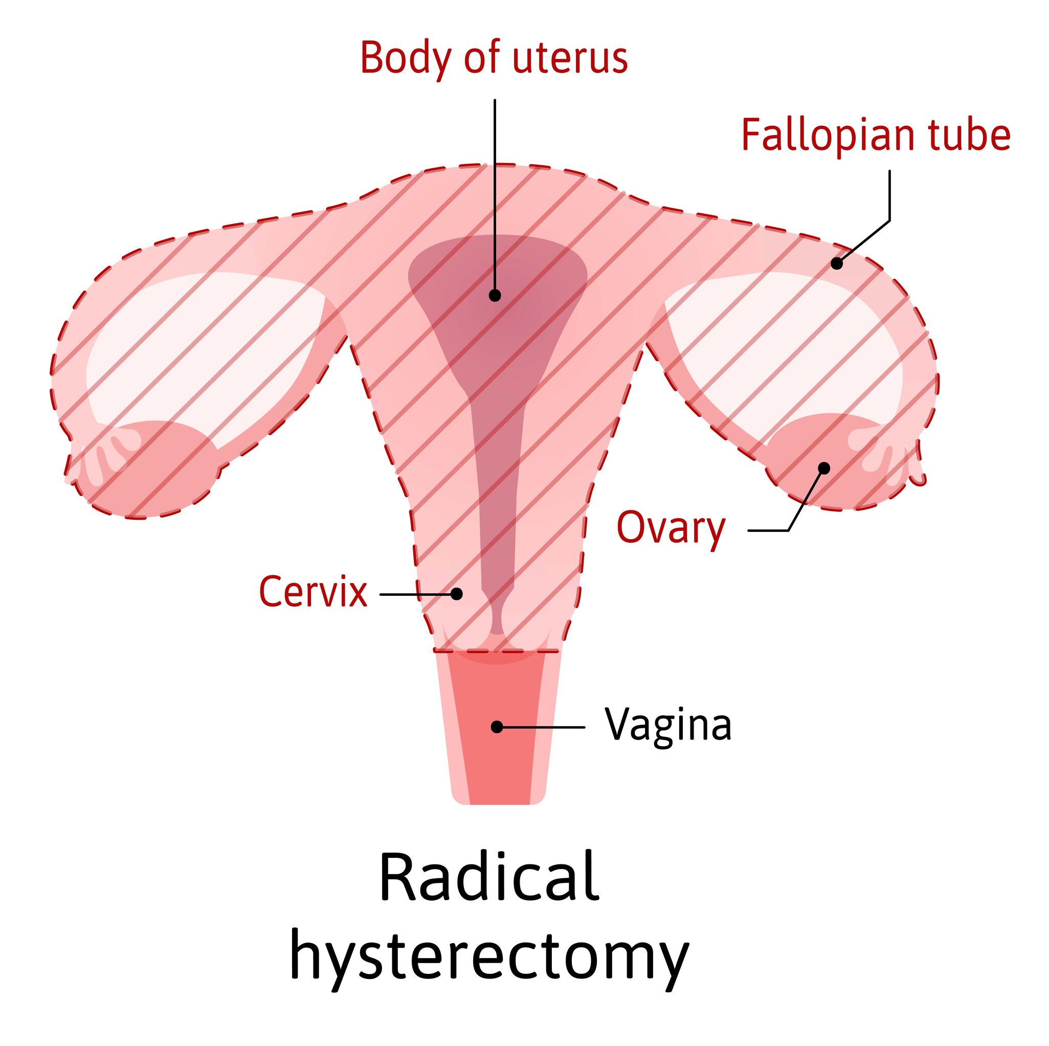 Hysterectomy Reasons, Types, and Risks Ask Dr. Angela